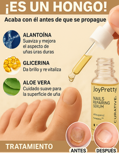 JoyPretty™ ¡Elimina los hongos de tus uñas de raíz!