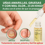 JoyPretty™ ¡Elimina los hongos de tus uñas de raíz!