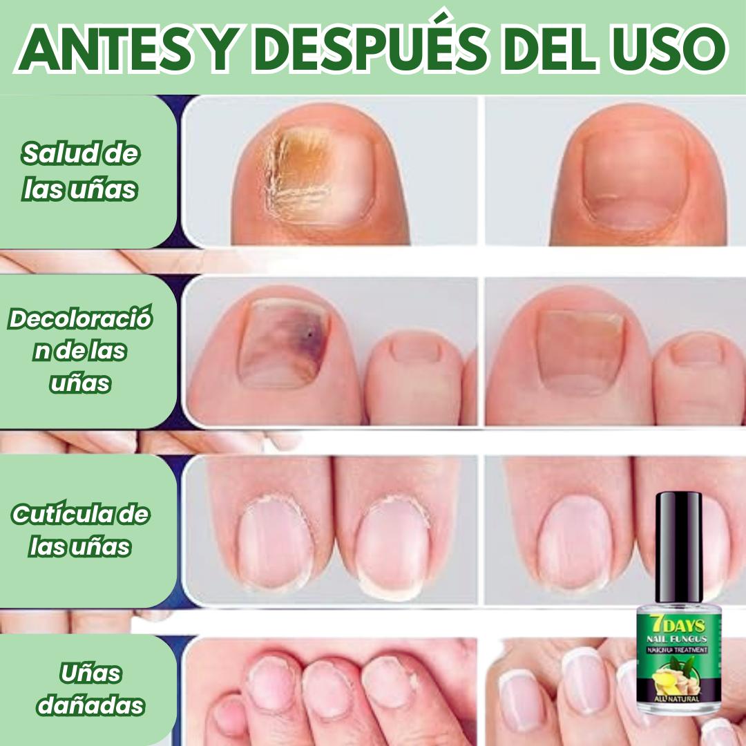 JoyPretty™ ¡Elimina los hongos de tus uñas de raíz!