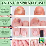 JoyPretty™ ¡Elimina los hongos de tus uñas de raíz!