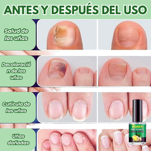 JoyPretty™ ¡Elimina los hongos de tus uñas de raíz!
