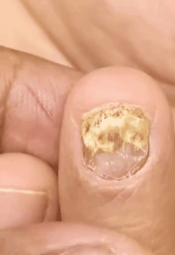JoyPretty™ ¡Elimina los hongos de tus uñas de raíz!