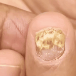 JoyPretty™ ¡Elimina los hongos de tus uñas de raíz!